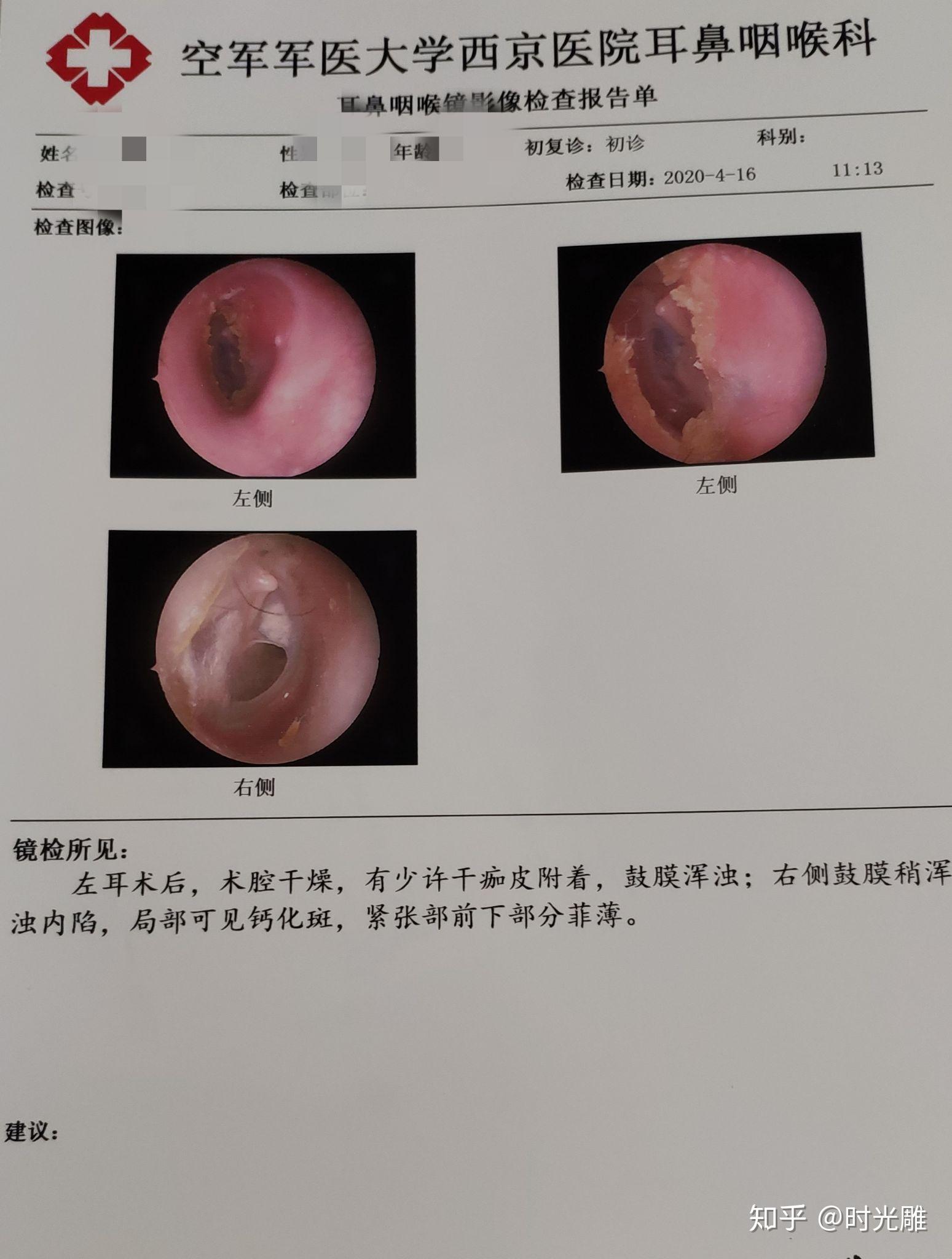 耳膜穿孔的修复过程，六个月的长好之路